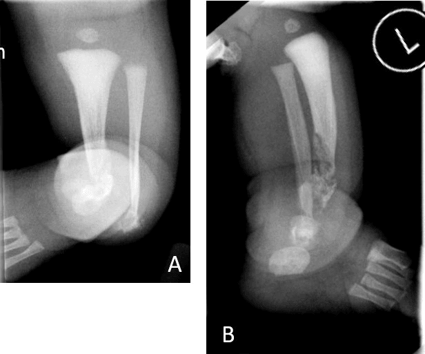 Neonatal AP and lateral radiographs, panels A and B, showing mixed lytic-sclerotic lesions of the distal tibia and fibula