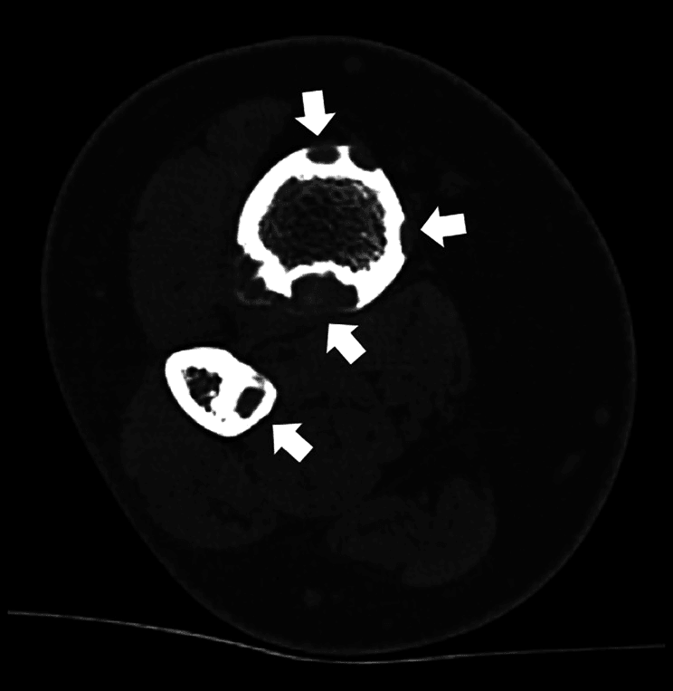 Axial CT of the leg showing well-defined intracortical osteofibrous dysplasia, arrows marking lesions in the tibia and fibula