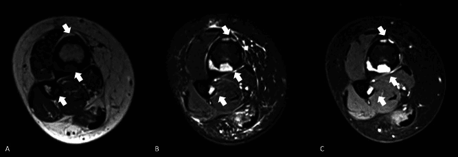 Axial MRI in three sequences, panels A to C, of multifocal tibial osteofibrous dysplasia, arrows marking the cortical lesions