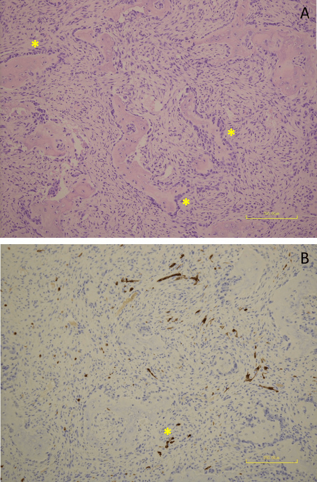 Histology of osteofibrous dysplasia: panel A showing woven bone with osteoblastic rimming, panel B an immunostain with scattered positive cells