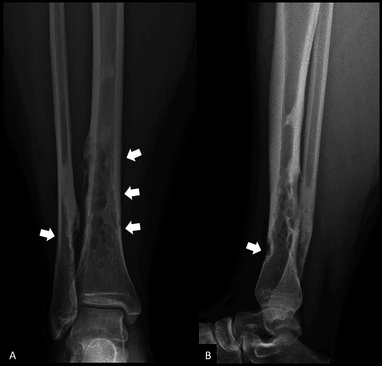 AP and lateral radiographs of the distal leg showing multifocal cortical osteofibrous dysplasia, arrows marking the lesions