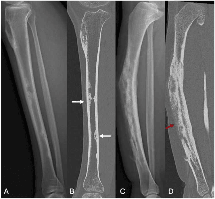 Radiographs and CT of osteofibrous dysplasia and adamantinoma compared, panels A to D