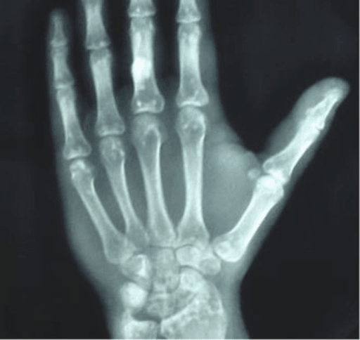 PA hand radiograph showing multiple small round sclerotic foci in carpals, metacarpal heads and phalanges in osteopoikilosis