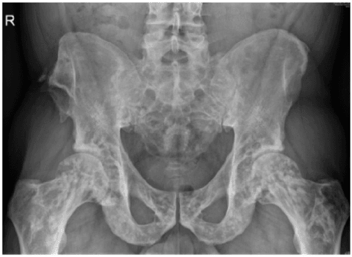 AP pelvis radiograph showing numerous small round sclerotic foci clustered around both hips, acetabula and iliac wings in osteopoikilosis