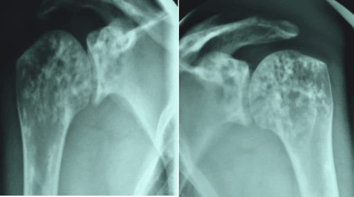 AP radiographs of both shoulders showing clustered sclerotic foci in the proximal humeri and glenoid in osteopoikilosis
