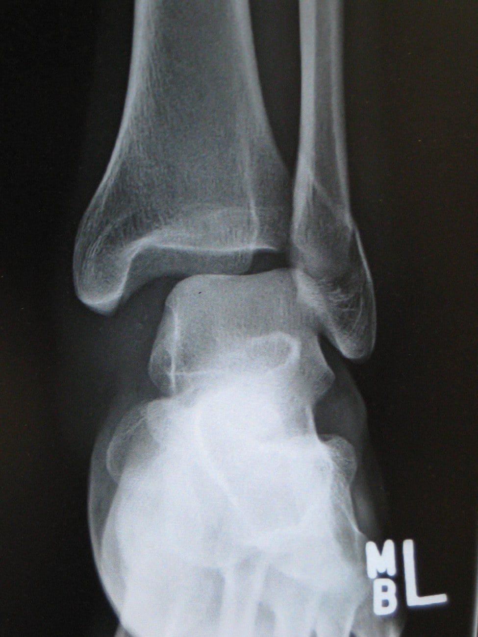 AP/mortise ankle radiograph showing a distal fibular (lateral malleolus) fracture with widening of the ankle mortise