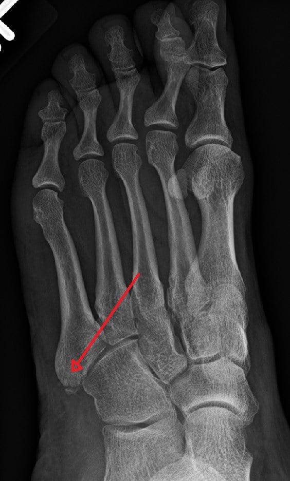 AP foot radiograph with an arrow indicating a fracture at the base of the fifth metatarsal