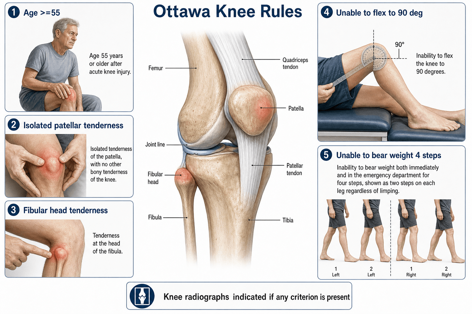 Ottawa Knee Rules: the five criteria (age 55+, isolated patellar tenderness, fibular head tenderness, inability to flex to 90 degrees, inability to bear weight 4 steps) with labelled knee anatomy