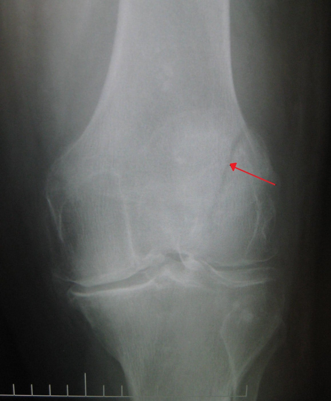 AP knee radiograph showing a vertical patella fracture (arrow), with the distal femur, proximal tibia and fibular head visible.