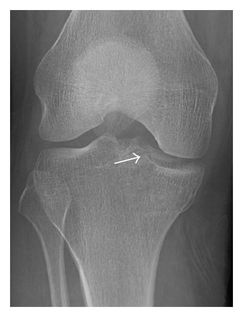 AP knee radiograph showing a subtle lateral tibial plateau fracture (arrow) at the proximal tibia.