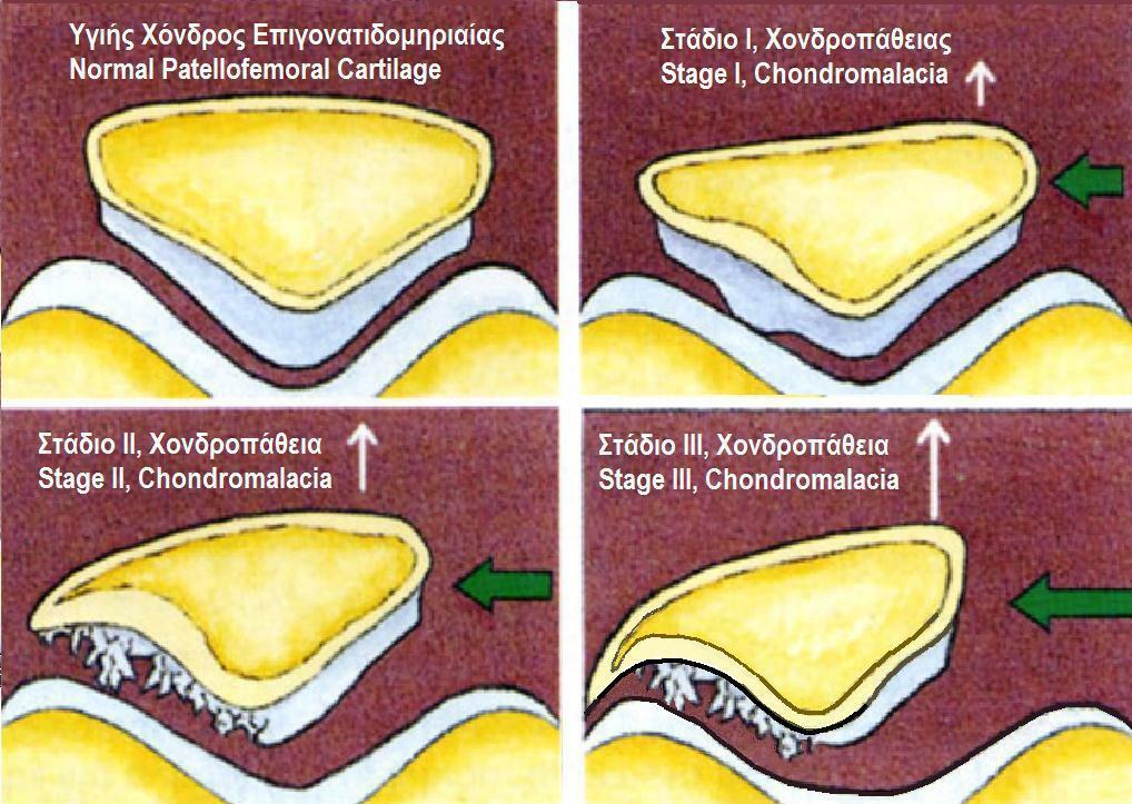 Illustration of normal patellofemoral cartilage and stages I-III chondromalacia showing progressive softening, fibrillation and fissuring of the cartilage surface.