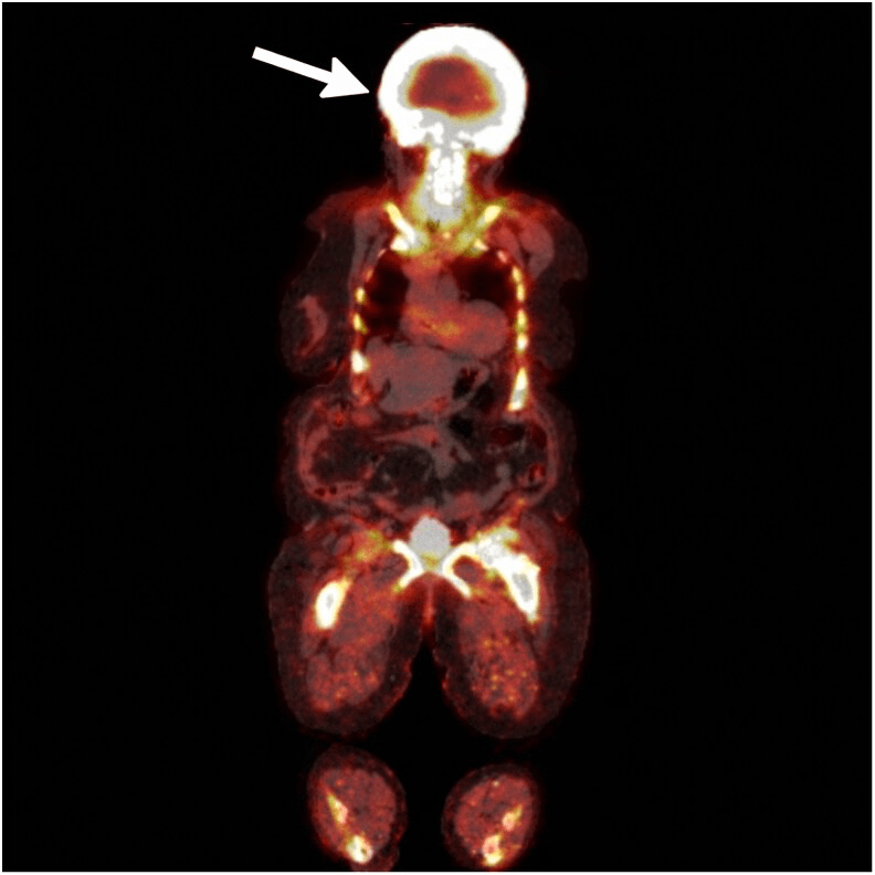 Whole-body NaF PET/CT image with intense uptake throughout the calvarium (arrow) in active cranial Paget disease