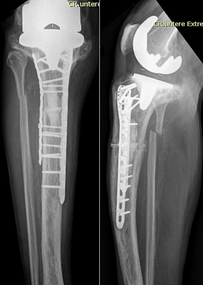 Six-week postoperative tibial radiographs showing early union without hardware loosening