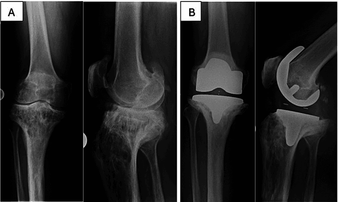 Panel A: preoperative AP and lateral knee radiographs with pagetic proximal-tibial deformity. Panel B: AP and lateral radiographs after total knee arthroplasty