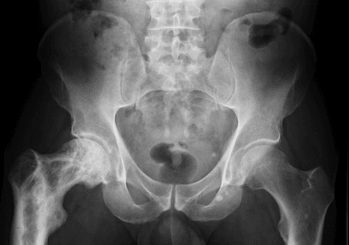 AP pelvic radiograph showing an expanded, deformed pagetic right proximal femur with a lateral-cortex pseudofracture