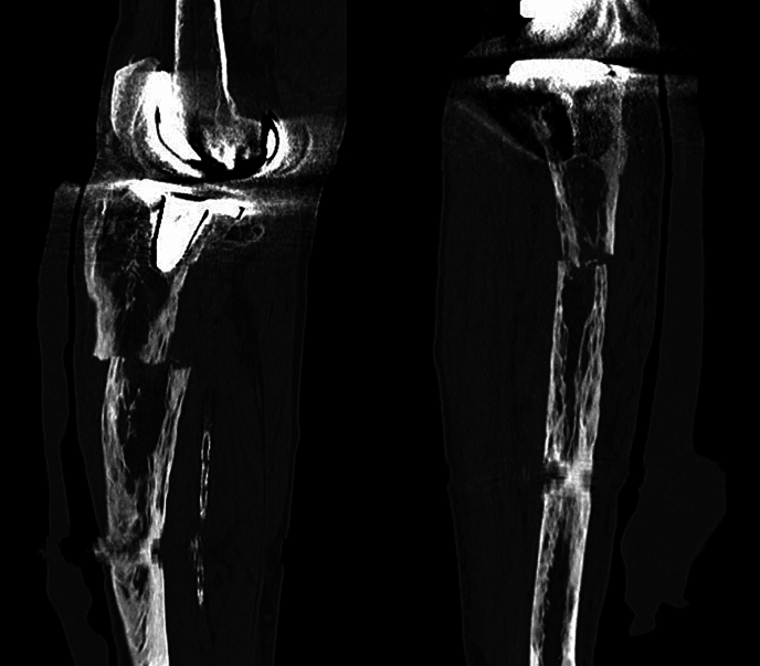 Sagittal and coronal CT of a proximal tibia beneath a knee replacement, showing mixed osteolytic and osteosclerotic Paget change and a shaft fracture