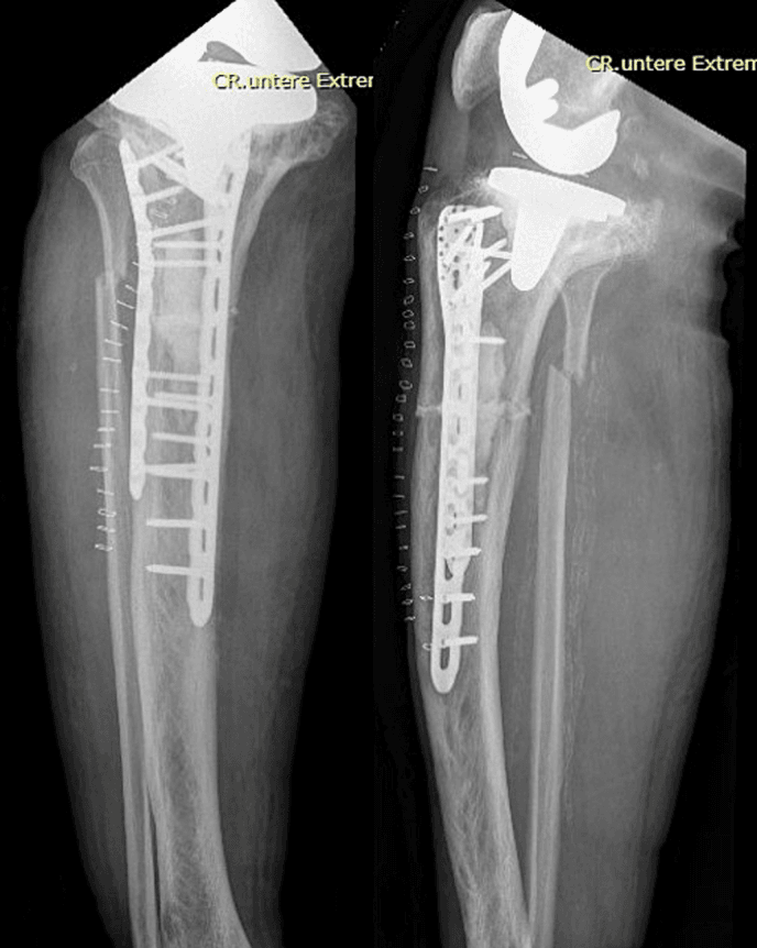 Postoperative AP and lateral radiographs showing dual plate fixation of a pagetic proximal tibial fracture, skin staples in place