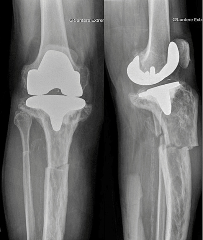 AP and lateral radiographs showing an angulated transverse proximal tibial-shaft fracture through pagetic bone below a total knee replacement