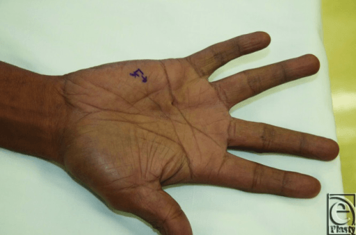 Palm showing a firm nodule near the ring finger distal palmar crease with a small skin pit.
