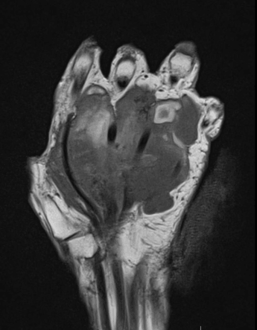 Coronal MRI of the hand showing a large soft-tissue mass in the palm with intact bones.