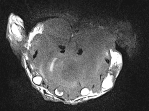 Axial MRI of the hand with a large soft-tissue mass in the palm, bones appearing uninvolved.