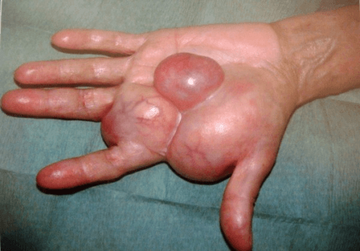 Palm of left hand with a large nodular swelling spanning the first four rays.