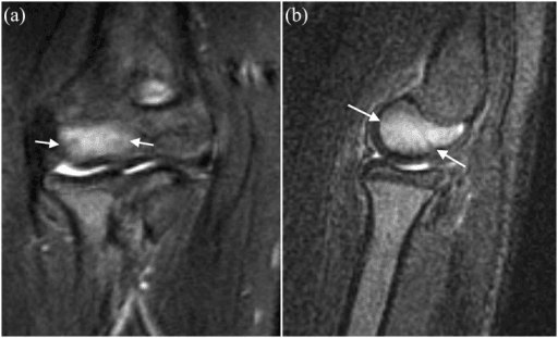 Two-panel elbow MRI - coronal and sagittal fat-saturated T2-weighted images showing bright high-signal bone marrow oedema throughout the capitellar epiphysis with white arrows