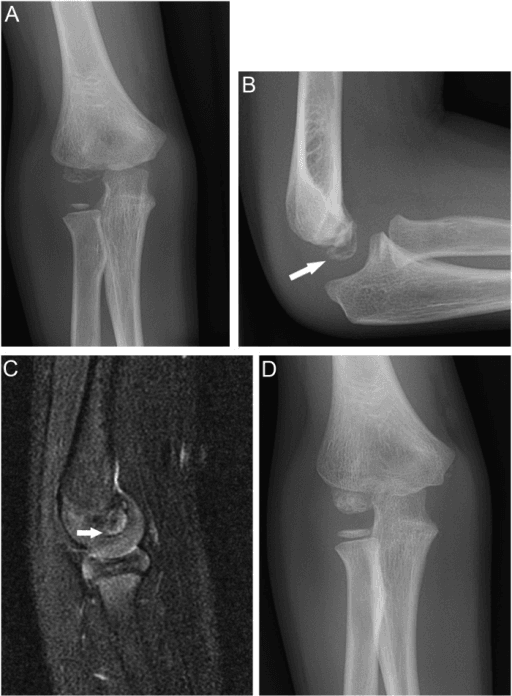 Four-panel imaging series in an 8-year-old boy - AP radiograph showing a fragmented but shape-preserved capitellum, lateral radiograph, sagittal MRI of the lesion, and a follow-up AP radiograph showing reconstitution