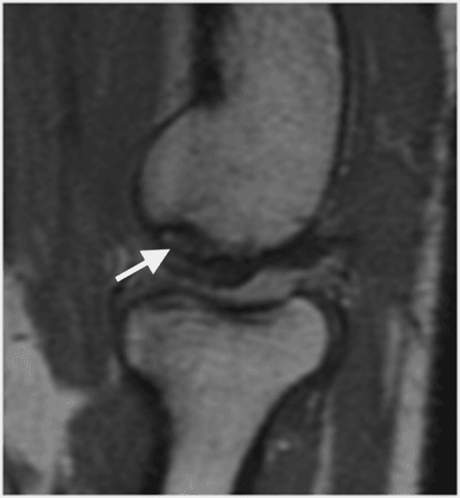Single sagittal proton-density elbow MRI showing an osteochondral lesion of the capitellum with irregularity of the articular surface and a white arrow