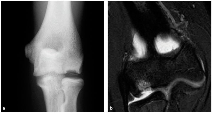 Radiograph and coronal MRI showing a focal capitellar osteochondritis dissecans lesion