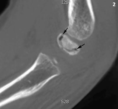Sagittal cone-beam CT showing a subchondral capitellar vacuum phenomenon in Panner disease