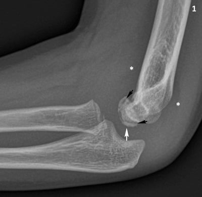 Lateral right-elbow radiograph in a child with Panner disease showing capitellar irregularity and effusion