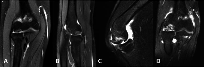 Coronal and sagittal MRI examples of small and large unstable capitellar OCD lesions