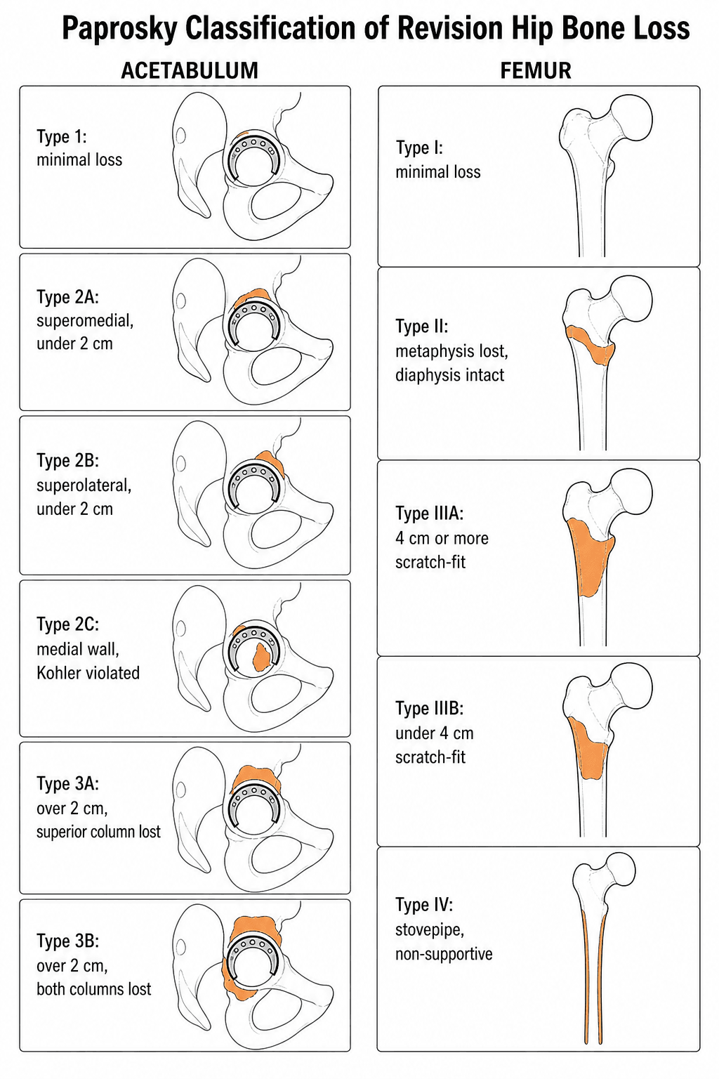 Two-column Paprosky classification chart: acetabular Types 1–3B by migration and column loss, femoral Types I–IV by metaphyseal/diaphyseal bone stock.