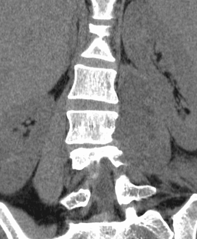 Coronal CT of the lumbar spine showing a paraspinal soft-tissue collection consistent with a paraspinal abscess.