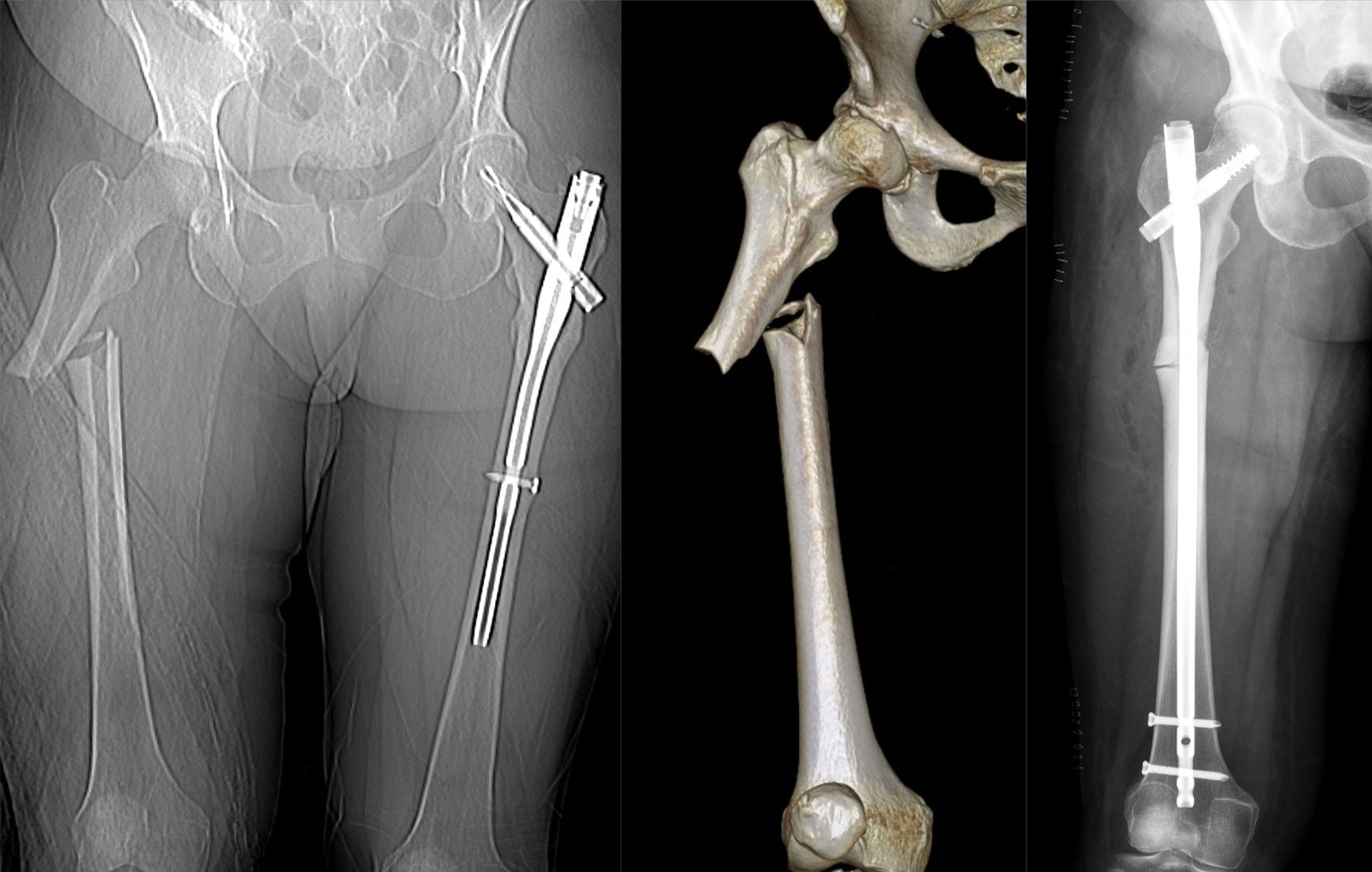 CT and radiographs of an atypical subtrochanteric femoral fracture associated with long-term bisphosphonate therapy.
