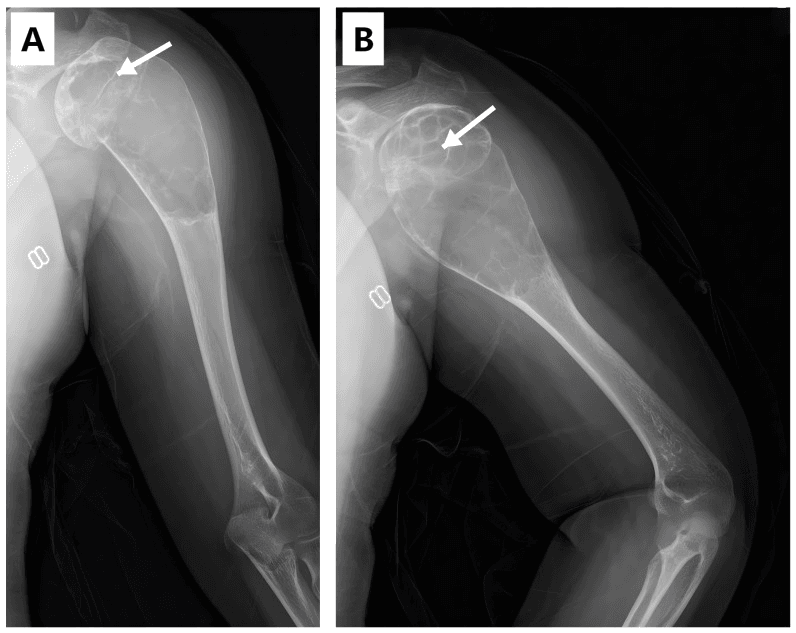 Paediatric proximal humerus radiographs showing a pathological fracture through an expansile aneurysmal bone cyst