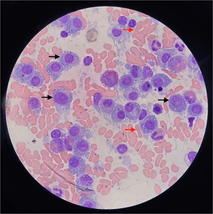 Bone marrow aspirate showing numerous plasma cells and rouleaux formation in oligosecretory myeloma