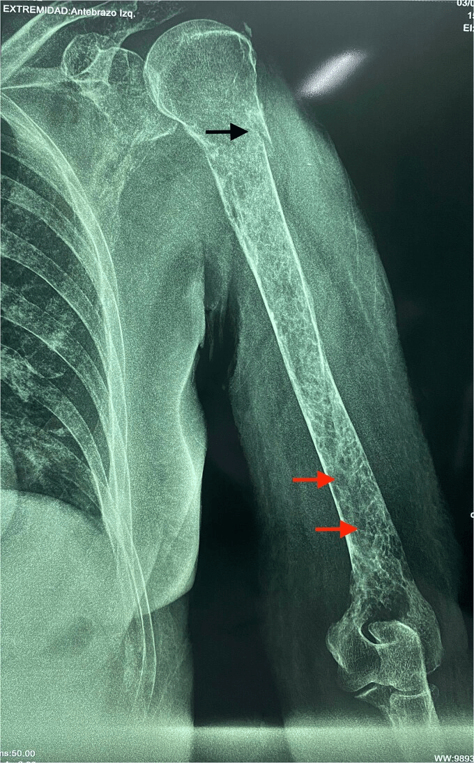 Left humerus radiograph showing a surgical-neck fracture and additional distal lytic lesions from multiple myeloma