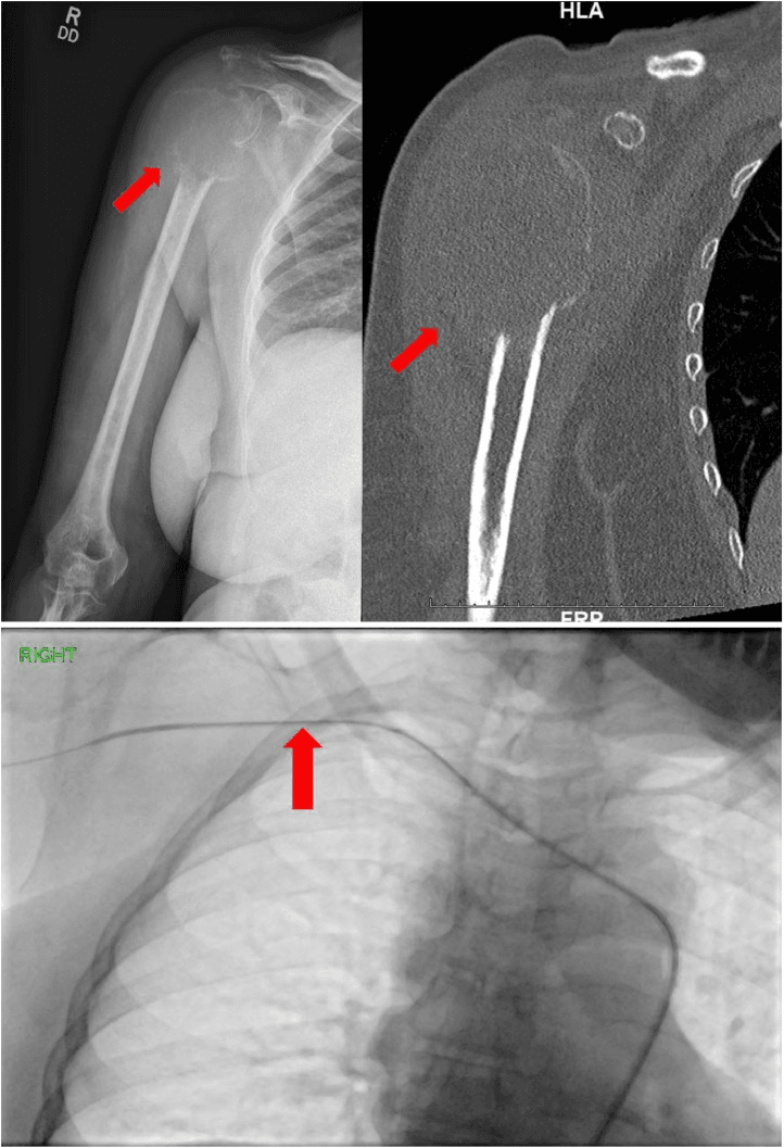 Humeral head plasmacytoma shown on radiograph and CT with angiographic catheter placement