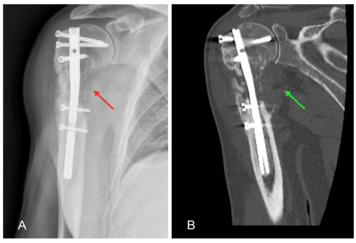 Radiograph and coronal CT showing progressive humeral osteolysis around an intramedullary nail