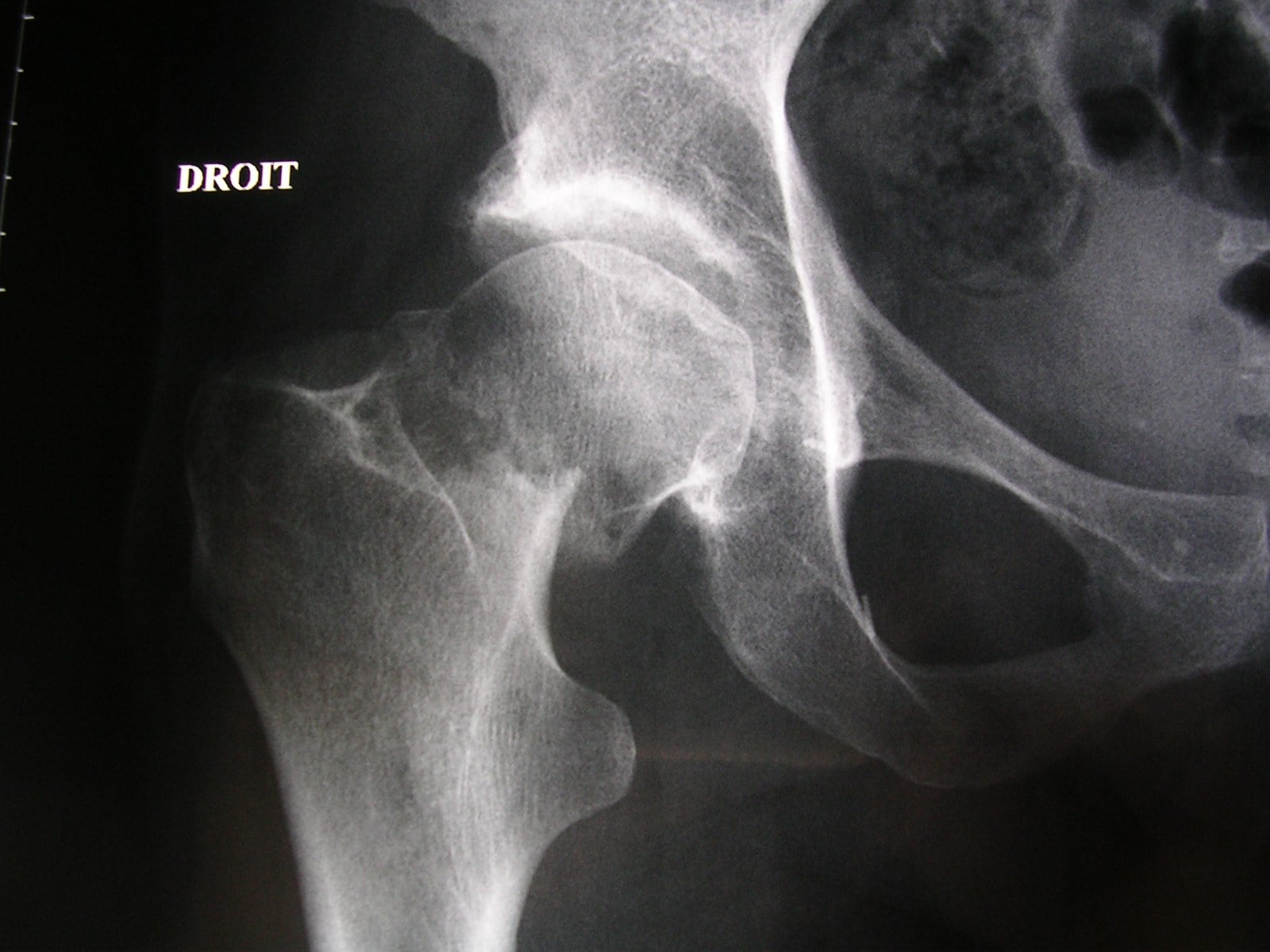 AP radiograph of a displaced right femoral neck fracture with disrupted Shenton's line