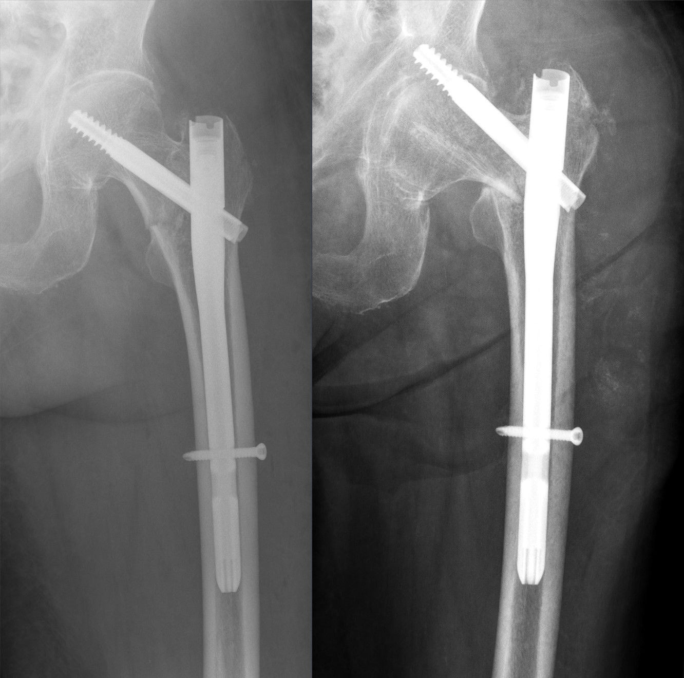 Serial AP hip radiographs showing the cephalic screw of a proximal femoral nail cutting out superiorly into the acetabulum