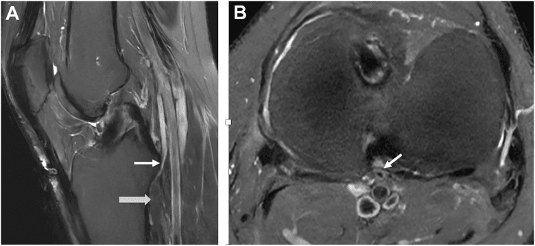Two knee MRI panels, A and B, with arrows on a high aberrant anterior tibial artery near the posterior tibia