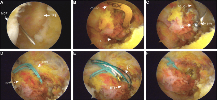 Six arthroscopic panels, A to F, with printed labels, showing PCL avulsion reduction and dual fixation