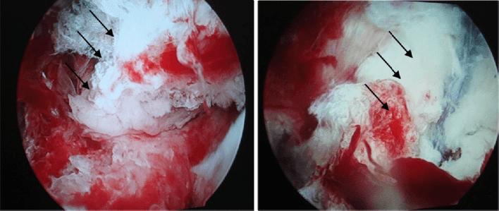 Two arthroscopic views, with arrows, of a PCL tibial avulsion before and after reduction