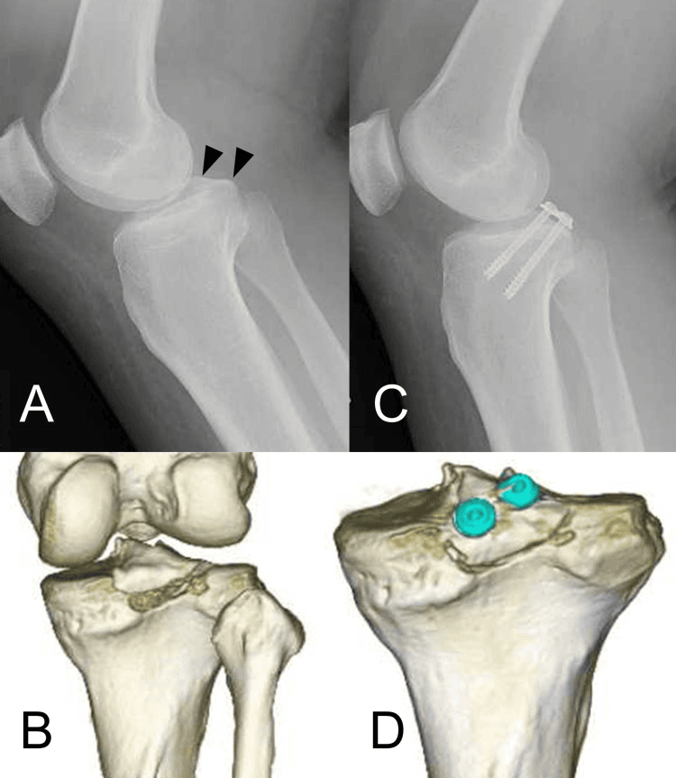 Lateral radiographs and three-dimensional CT of a PCL tibial avulsion before and after fixation with two screws