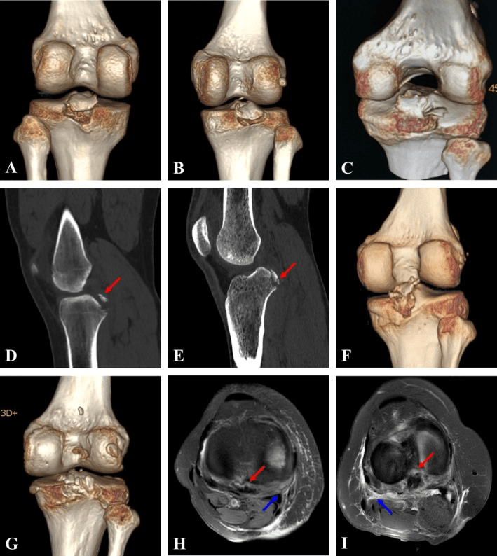 Nine-panel montage, A to I, of PCL tibial avulsions on three-dimensional CT, CT slices and MRI