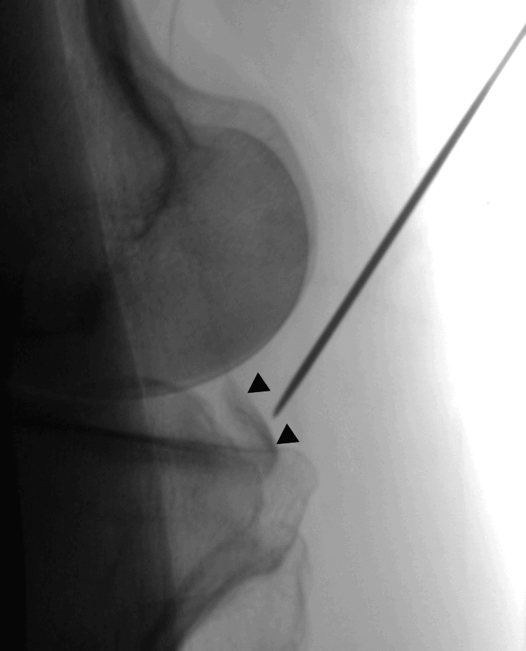 Lateral knee fluoroscopy showing a wire aimed at a PCL avulsion fragment marked by arrowheads