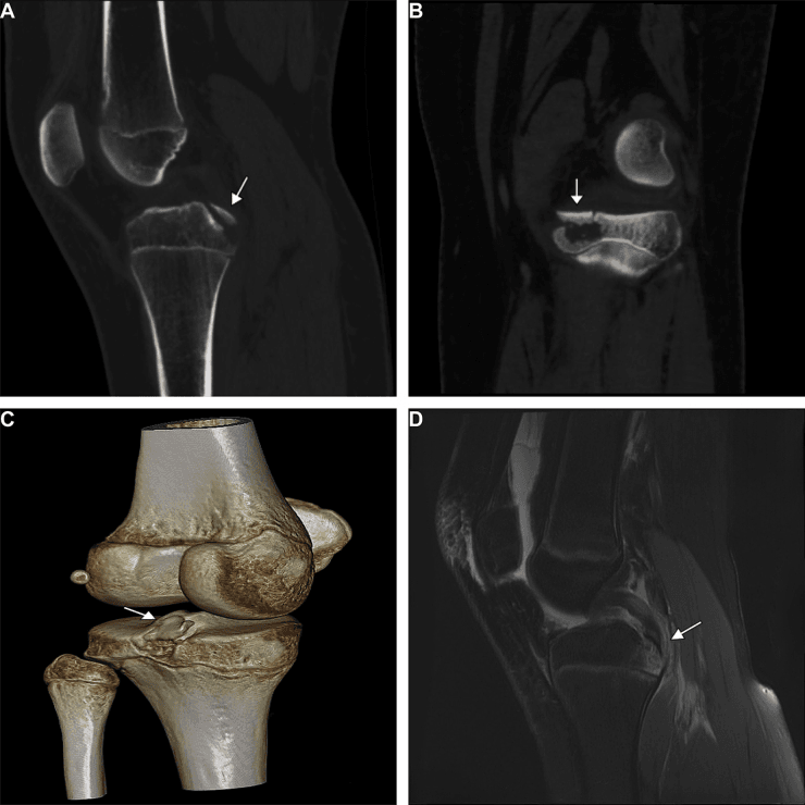 Four panels, A to D, of a PCL tibial avulsion on CT slices, three-dimensional CT and MRI, each with an arrow